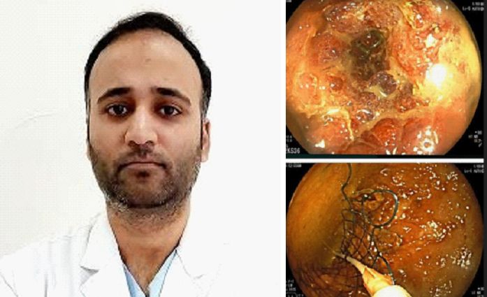 Advanced Endoscopic Technique Saves Life Of A Cancer Patient At Paras Health Srinagar