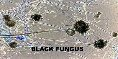 Centre asks States, UTs to make ‘black fungus’ notifiable disease under Epidemic Act