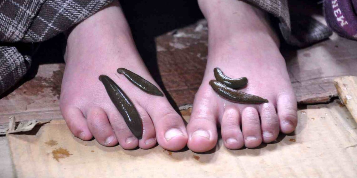 Leech Therapy: a traditional treatment to cure ailments on Navroz day in Kashmir