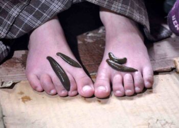 Leech Therapy: a traditional treatment to cure ailments on Navroz day in Kashmir
