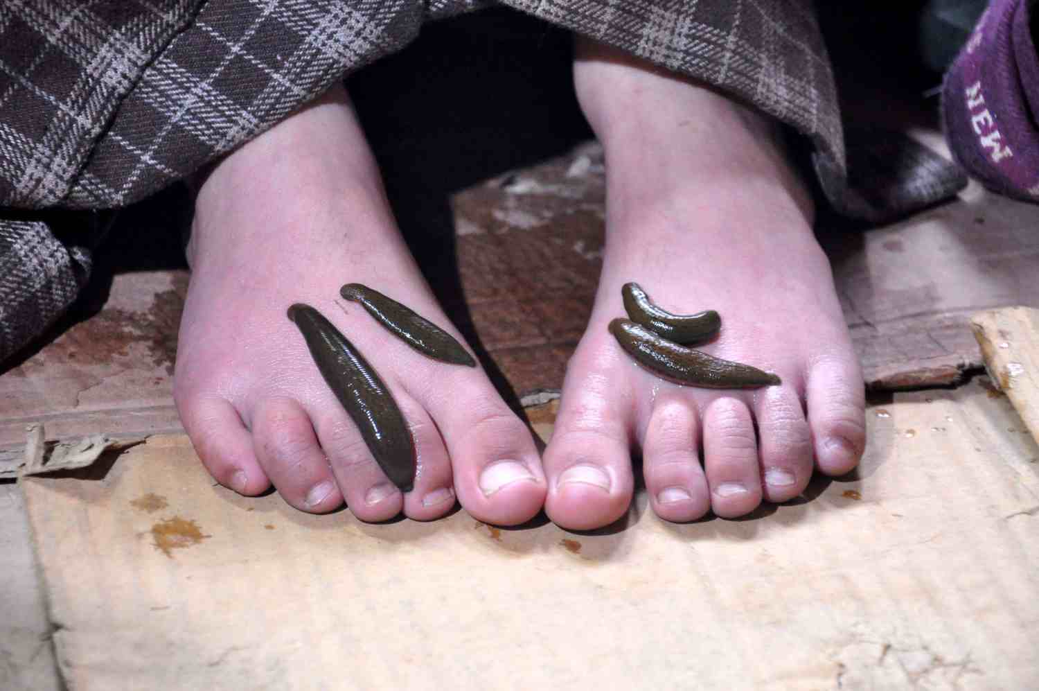 As many ailing people get leech therapy done in Kashmir on Navroz