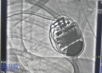 Paras Health Srinagar Saves Brazilian Patient in Rare, Life-Saving CRT-D Heart Procedure
