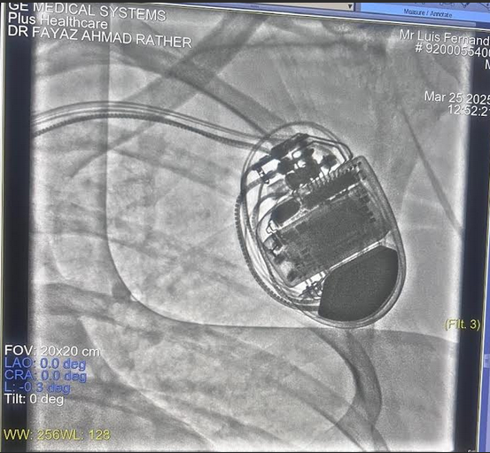 Paras Health Srinagar Saves Brazilian Patient in Rare, Life-Saving CRT-D Heart Procedure